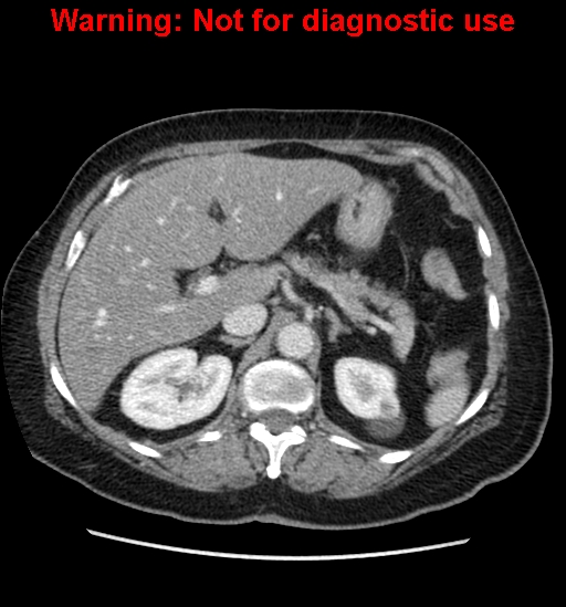 File:Bosniak renal cyst - type II (Radiopaedia 23404-23468 D 20).jpg