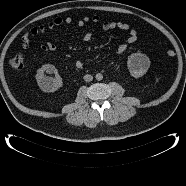 Bosniak renal cyst - type IV (Radiopaedia 24244-24518 Axial non-contrast 173).jpg