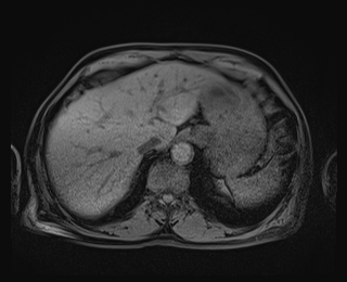 Bouveret syndrome (Radiopaedia 61017-68856 Axial T1 fat sat 15).jpg