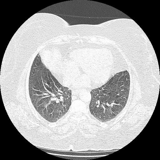 Bovine aortic arch - right internal mammary vein drains into the superior vena cava (Radiopaedia 63296-71875 Axial lung window 110).jpg