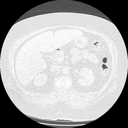 Bovine aortic arch - right internal mammary vein drains into the superior vena cava (Radiopaedia 63296-71875 Axial lung window 205).jpg
