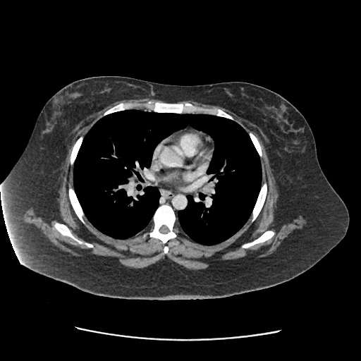 File:Bowel and splenic infarcts in acute lymphocytic leukemia (Radiopaedia 61055-68915 A 2).jpg
