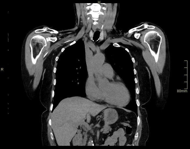 Brachial artery foreign body (Radiopaedia 54583-60820 Coronal non-contrast 22).jpg