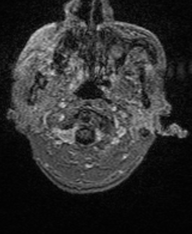 Brain abscess with dual rim sign (Radiopaedia 87566-103938 Axial T1 C+ 11).jpg
