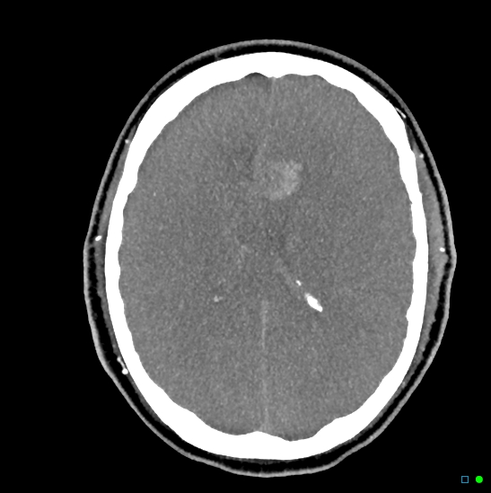 Brain death on MRI and CT angiography (Radiopaedia 42560-45841 B 22).jpg