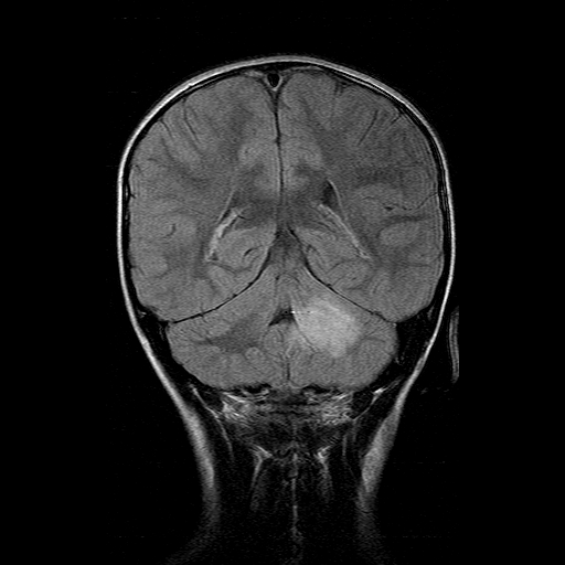 File:Brainstem ganglioglioma (Radiopaedia 10763-11224 Coronal FLAIR 7).jpg