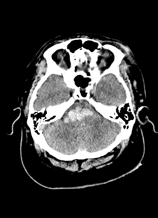 Brainstem hemorrhage (Radiopaedia 81294-94976 Axial non-contrast 46).jpg