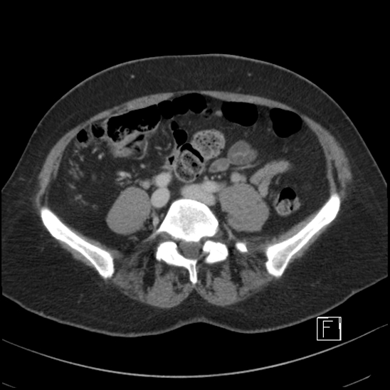 File:Breast metastases from renal cell cancer (Radiopaedia 79220-92225 C 74).jpg