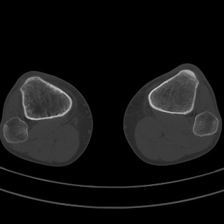 Brodie abscess - tibia (Radiopaedia 66028-75204 Axial bone window 1).jpg