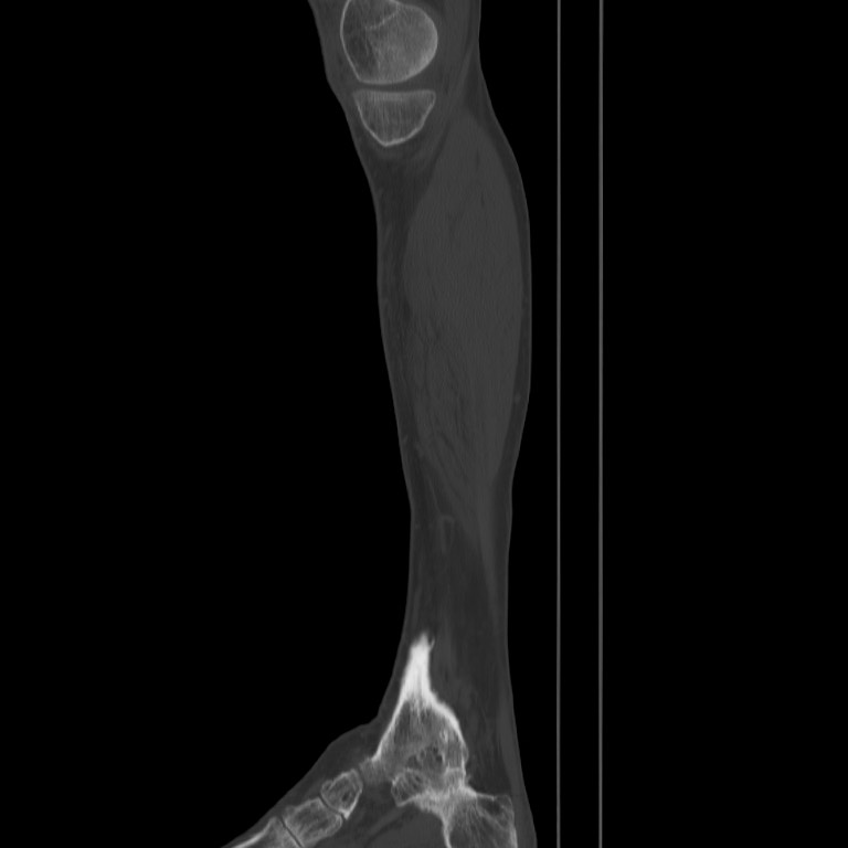 Brodie abscess - tibia (Radiopaedia 66028-75204 Sagittal bone window 2).jpg
