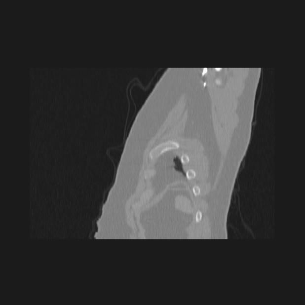 Bronchial atresia (Radiopaedia 60685-68439 Sagittal lung window 95).jpg