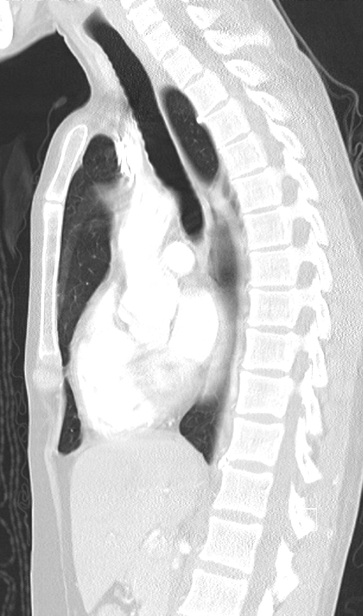 Bronchial atresia (Radiopaedia 73677-84470 Sagittal lung window 27).jpg