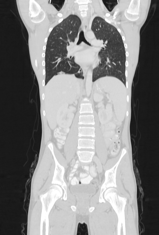 Bronchial carcinoid tumor (Radiopaedia 57187-64090 Coronal lung window 53).jpg