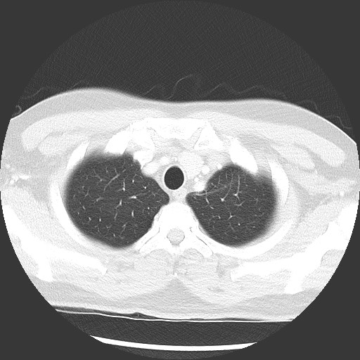 Bronchial carcinoid tumor (Radiopaedia 67377-76764 Axial lung window 13).jpg