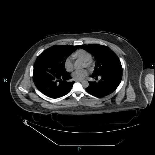 Bronchial carcinoid tumor (Radiopaedia 78272-90870 Axial non-contrast 57).jpg