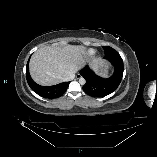 Bronchial carcinoid tumor (Radiopaedia 78272-90870 C 97).jpg