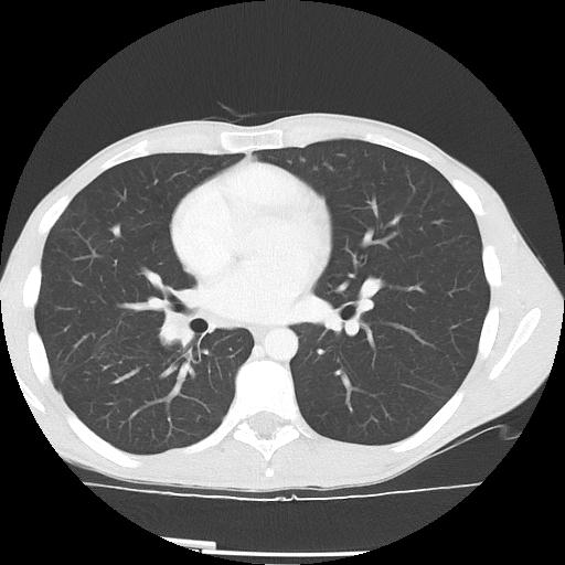 Bronchial carcinoid tumor causing right lower lobe collapse (Radiopaedia 83495-98594 Axial lung window 29).jpg