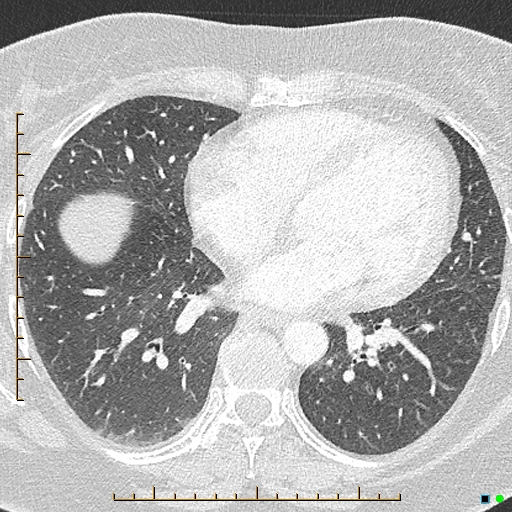 Bronchial diverticula (Radiopaedia 79512-92676 Axial lung window 128).jpg
