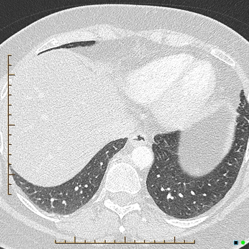 Bronchial diverticula (Radiopaedia 79512-92676 Axial lung window 168).jpg