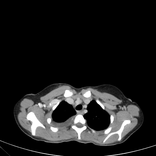 Bronchial mucoepidermoid carcinoma (Radiopaedia 57023-63895 Axial 21).jpg
