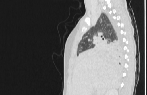 Bronchial mucoepidermoid carcinoma (Radiopaedia 57023-63895 Sagittal lung window 40).jpg