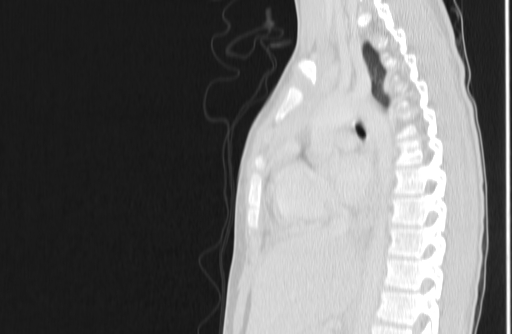 Bronchial mucoepidermoid carcinoma (Radiopaedia 57023-63895 Sagittal lung window 94).jpg