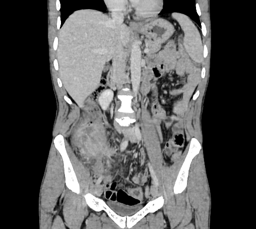 File:Bronchiectasis in Crohn disease (Radiopaedia 60311-67977 C 37).jpg