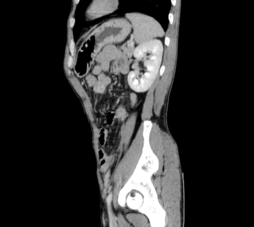 Bronchiectasis in Crohn disease (Radiopaedia 60311-67977 D 87).jpg