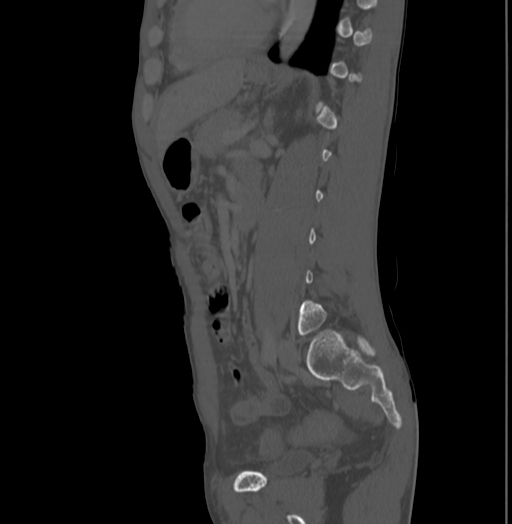 Bronchiectasis in Crohn disease (Radiopaedia 60311-67977 Sagittal bone window 159).jpg