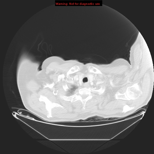 File:Bronchioloalveolar carcinoma (Radiopaedia 9272-9955 Axial lung window 1).jpg