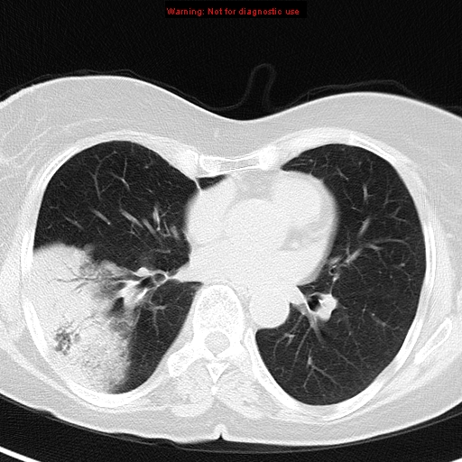File:Bronchoalveolar carcinoma (BAC) (Radiopaedia 13436-13392 Axial lung window 29).jpg