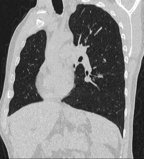 File:Bronchocele (Radiopaedia 60676-68429 Oblique lung window 10).jpg
