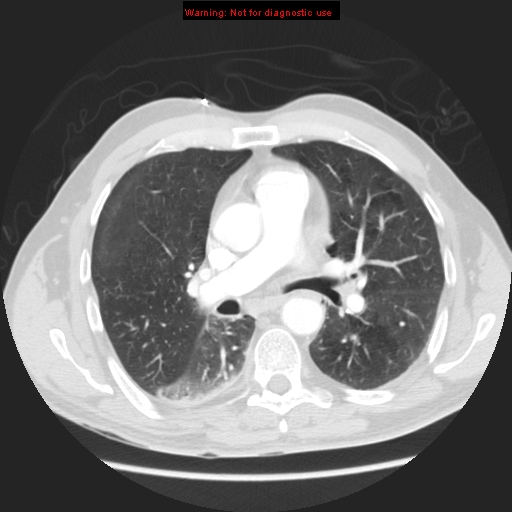 File:Bronchogenic carcinoma brain metastasis (Radiopaedia 9286-105832 Axial lung window 2).jpg