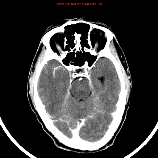 File:Bronchogenic carcinoma brain metastasis (Radiopaedia 9286-9970 B 10).jpg
