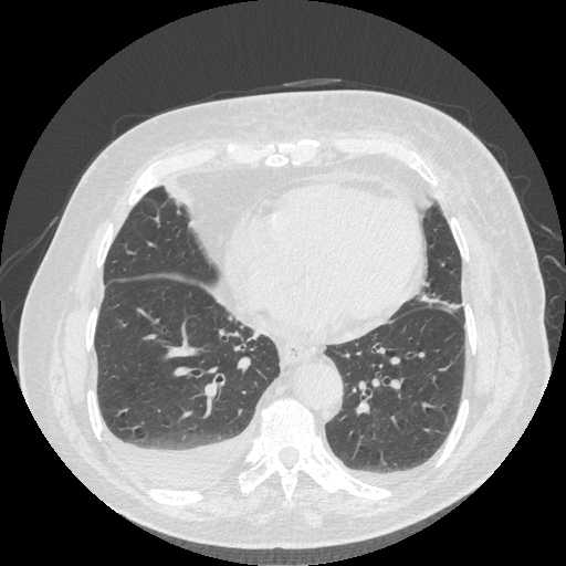 Bronchogenic carcinoma with metastatic lymphadenopathy (Radiopaedia 37671-39569 Axial lung window 38).jpg