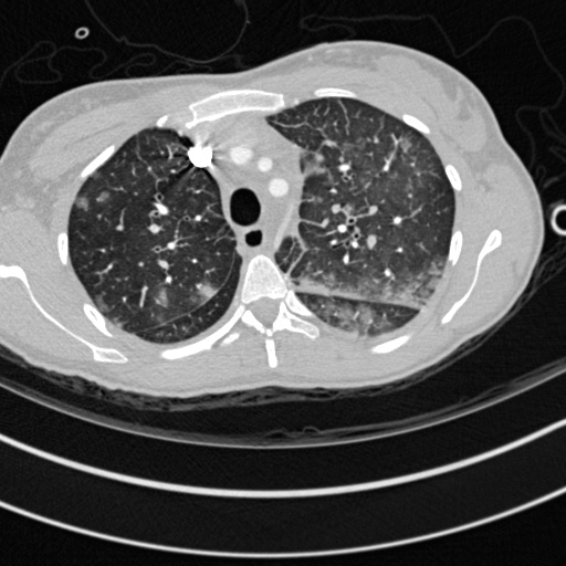 Bronchogenic cyst (Radiopaedia 77801-90071 Axial lung window 12).jpg