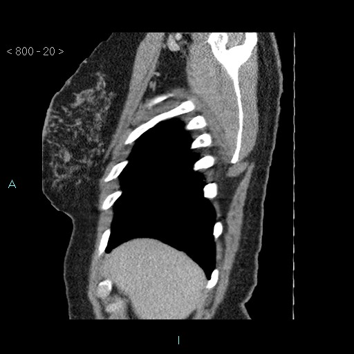 File:Bronchogenic cyst - posterior mediastinal (Radiopaedia 43885-47364 B 13).jpg