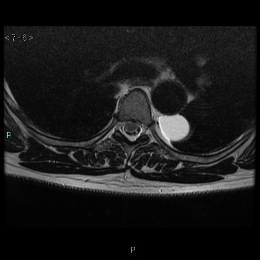 File:Bronchogenic cyst - posterior mediastinal (Radiopaedia 43885-47365 Axial T2 6).jpg