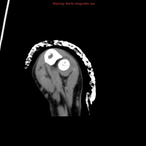 File:Brown tumor (Radiopaedia 12460-12694 Axial non-contrast 126).jpg