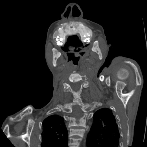 File:Brown tumor with secondary hyperparathyroidism (Radiopaedia 23591-23705 C 23).jpg