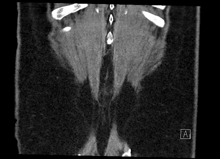Buried bumper syndrome - gastrostomy tube (Radiopaedia 63843-72577 Coronal Inject 133).jpg