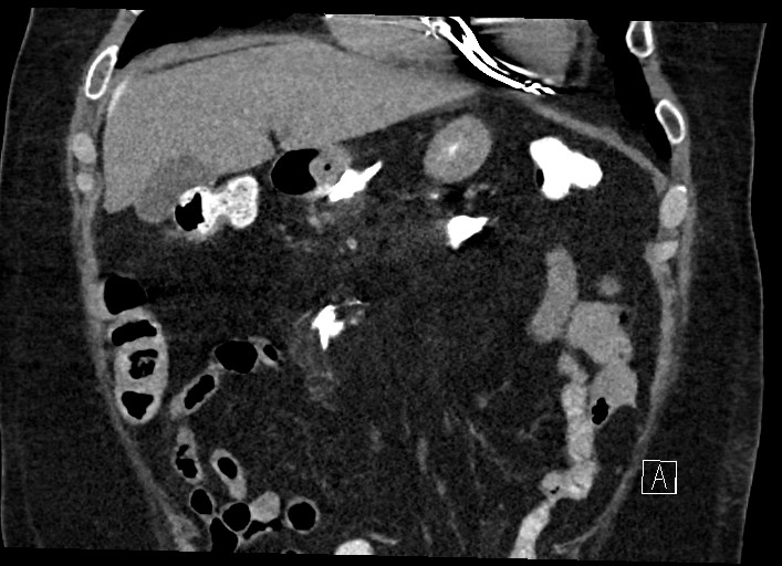 Buried bumper syndrome - gastrostomy tube (Radiopaedia 63843-72577 Coronal Inject 44).jpg