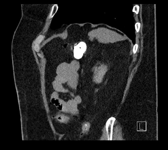 Buried bumper syndrome - gastrostomy tube (Radiopaedia 63843-72577 Sagittal Inject 21).jpg