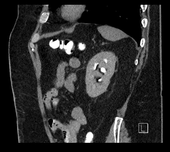 Buried bumper syndrome - gastrostomy tube (Radiopaedia 63843-72577 Sagittal Inject 27).jpg