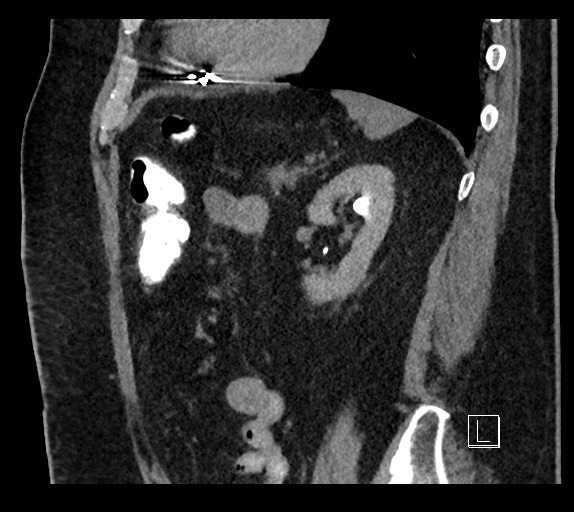 Buried bumper syndrome - gastrostomy tube (Radiopaedia 63843-72577 Sagittal Inject 36).jpg