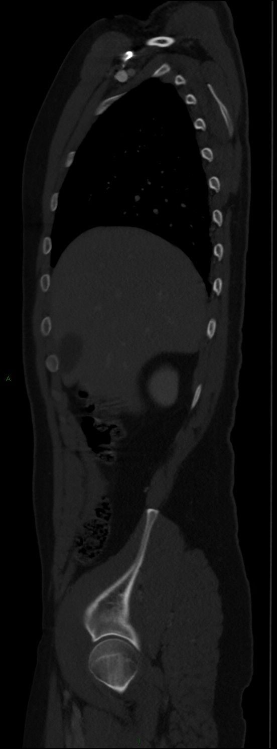 Burst fracture (Radiopaedia 83168-97542 Sagittal bone window 39).jpg