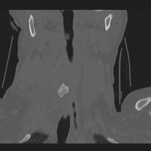 C2 fracture (Radiopaedia 34091-35341 Coronal bone window 10).png