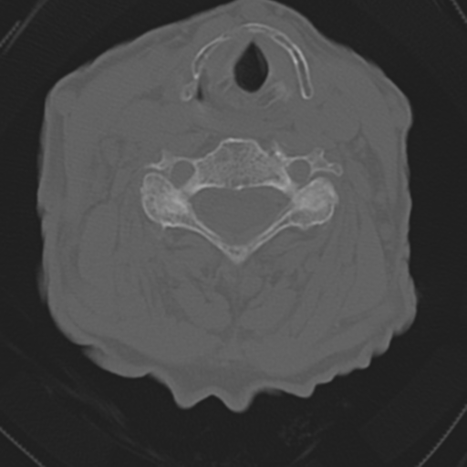 File:C2 fracture with vertebral artery dissection (Radiopaedia 37378-39199 Axial bone window 32).png