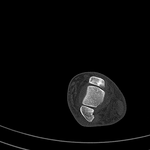 Calcaneal fracture - Sanders type 4 (Radiopaedia 90179-107370 Axial bone window 23).jpg