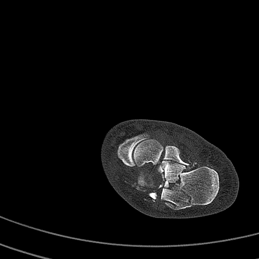 Calcaneal fracture - Sanders type 4 (Radiopaedia 90179-107370 Axial bone window 33).jpg